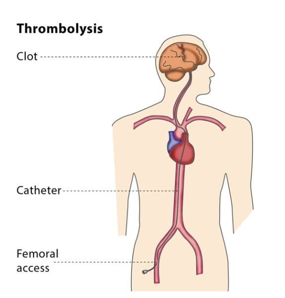 Understanding the Thrombolysis Procedure: A Comprehensive Guide